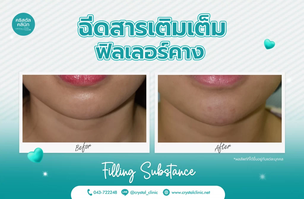 รีวิวฉีดฟิลเลอร์คาง (Filler) คริสตัลคลินิก มหาสารคาม 5 รีวิวฉีดฟิลเลอร์คาง (Filler) คริสตัลคลินิก มหาสารคาม 5