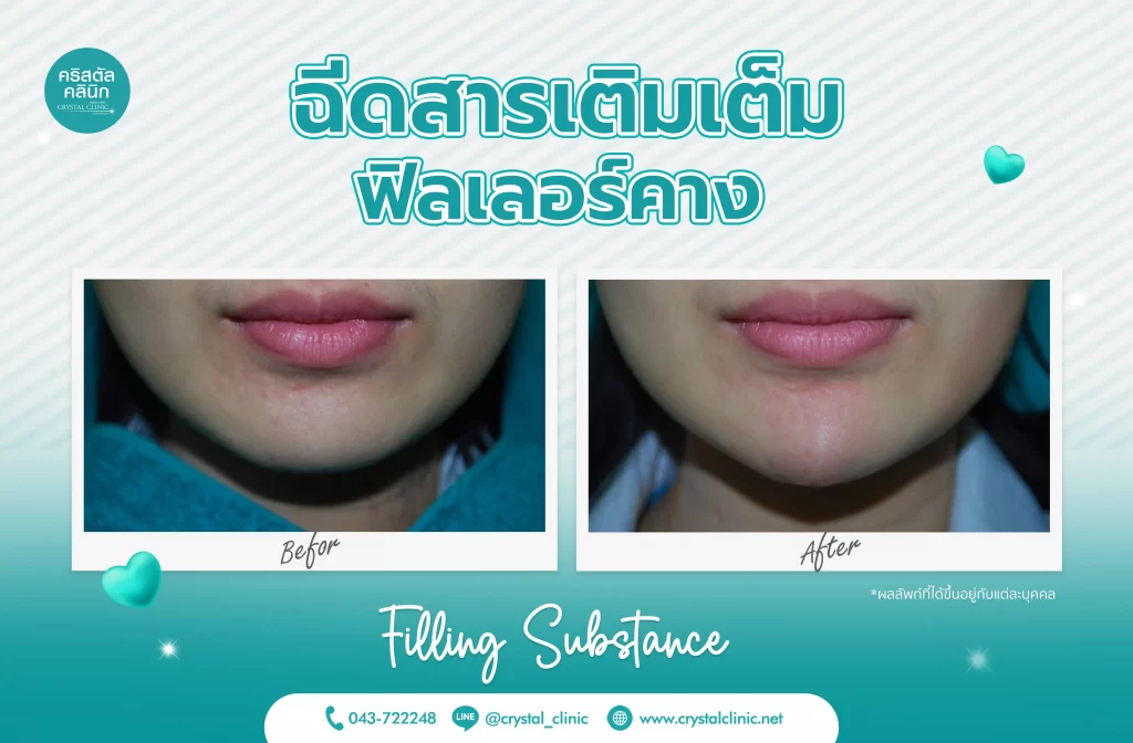รีวิวฉีดฟิลเลอร์คาง (Filler) คริสตัลคลินิก มหาสารคาม 6 รีวิวฉีดฟิลเลอร์คาง (Filler) คริสตัลคลินิก มหาสารคาม 6
