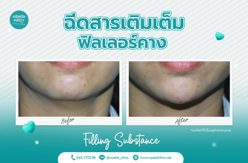 รีวิวฉีดฟิลเลอร์คาง (Filler) คริสตัลคลินิก มหาสารคาม 7 รีวิวฉีดฟิลเลอร์คาง (Filler) คริสตัลคลินิก มหาสารคาม 7