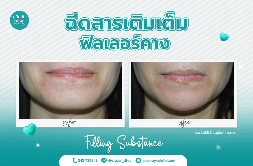 รีวิวฉีดฟิลเลอร์คาง (Filler) คริสตัลคลินิก มหาสารคาม 8 รีวิวฉีดฟิลเลอร์คาง (Filler) คริสตัลคลินิก มหาสารคาม 8