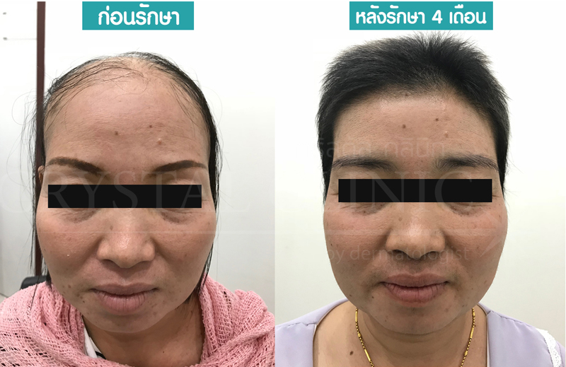 รักษาผมร่วง ผมบาง ปลูกผม คริสตัลคลินิก มหาสารคาม รักษาผมร่วง ผมบาง ปลูกผม คริสตัลคลินิก มหาสารคาม