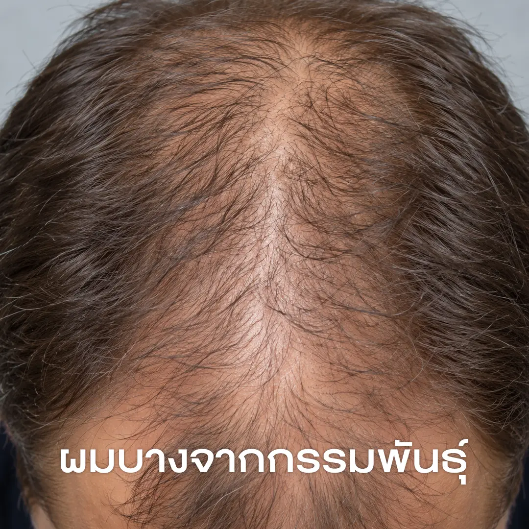 ผมบางจากกรรมพันธุ์-Androgenetic Alopecia