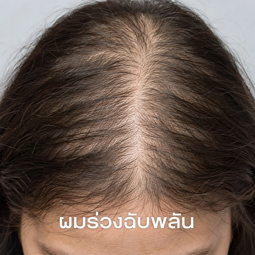 ผมร่วงฉับพลัน-Telogen Effluvium