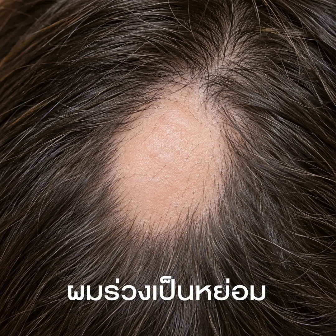 ผมร่วงเป็นหย่อม-Alopecia Areata