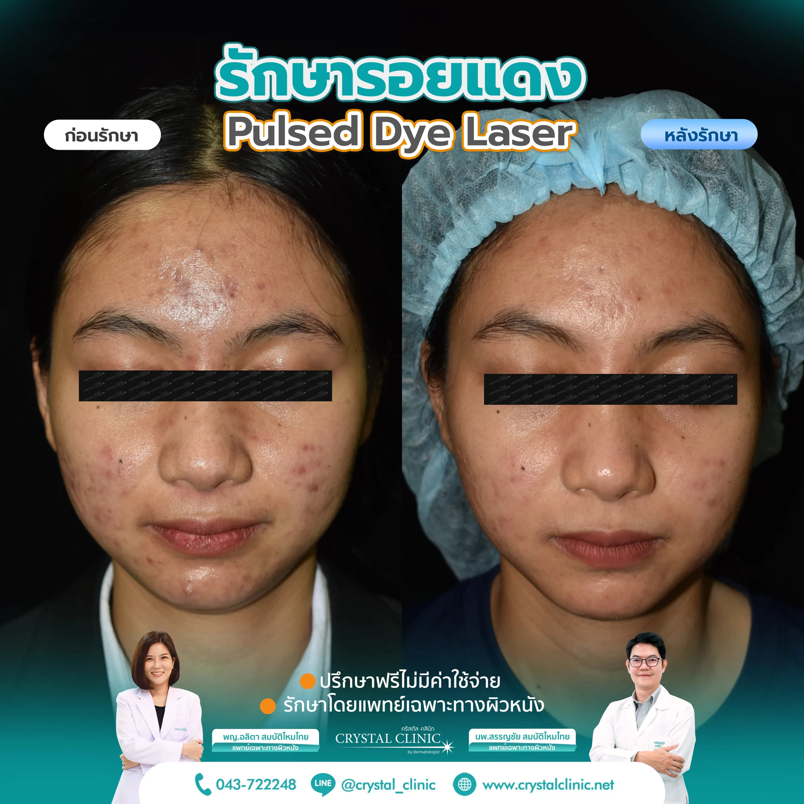 PDL Laser รักษารอยแดง รอยแดงสิว ด้วยเลเซอร์ คริสตัลคลินิก มหาสารคาม