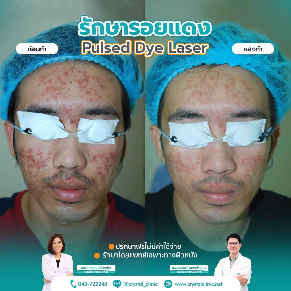 PDL Laser รักษารอยแดง รอยแดงสิว ด้วยเลเซอร์ คริสตัลคลินิก มหาสารคาม PDL Laser รักษารอยแดง รอยแดงสิว ด้วยเลเซอร์ คริสตัลคลินิก มหาสารคาม