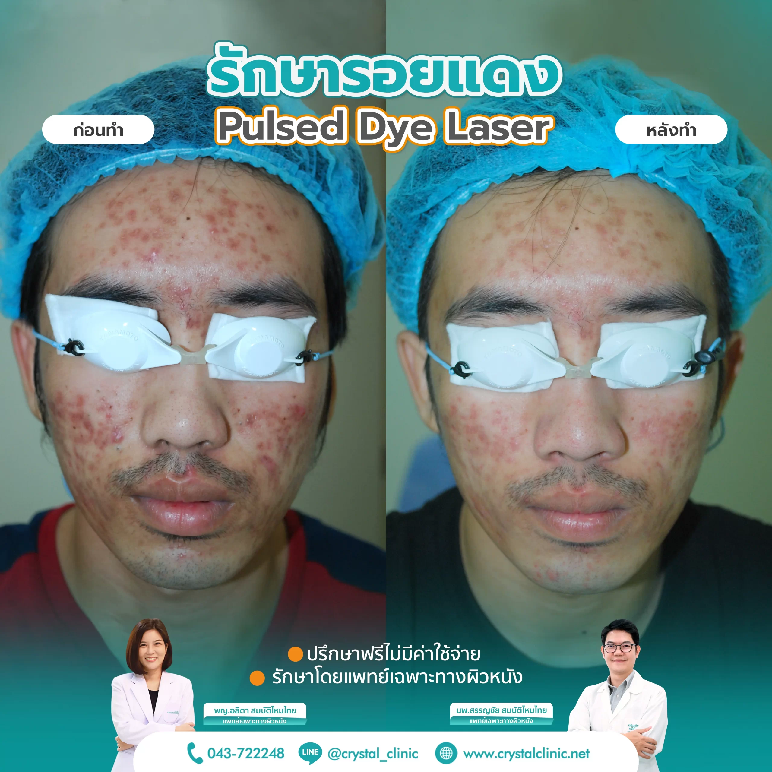 PDL Laser รักษารอยแดง รอยแดงสิว ด้วยเลเซอร์ คริสตัลคลินิก มหาสารคาม
