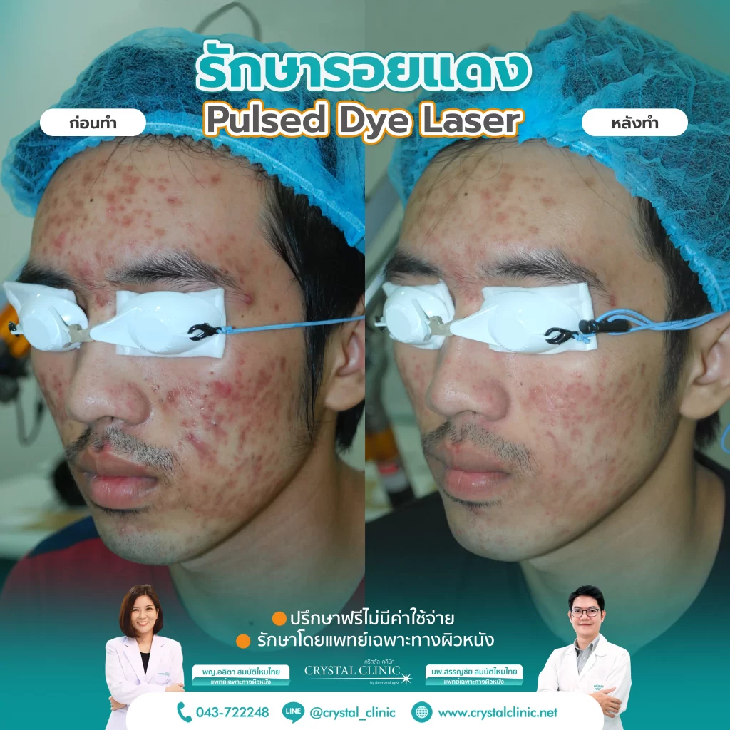 PDL Laser รักษารอยแดง รอยแดงสิว ด้วยเลเซอร์ คริสตัลคลินิก มหาสารคาม PDL Laser รักษารอยแดง รอยแดงสิว ด้วยเลเซอร์ คริสตัลคลินิก มหาสารคาม