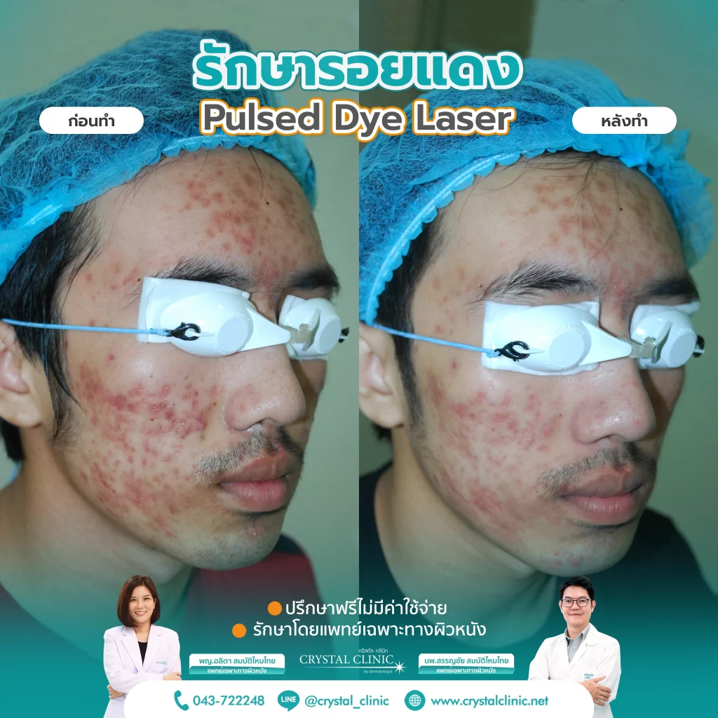 PDL Laser รักษารอยแดง รอยแดงสิว ด้วยเลเซอร์ คริสตัลคลินิก มหาสารคาม PDL Laser รักษารอยแดง รอยแดงสิว ด้วยเลเซอร์ คริสตัลคลินิก มหาสารคาม