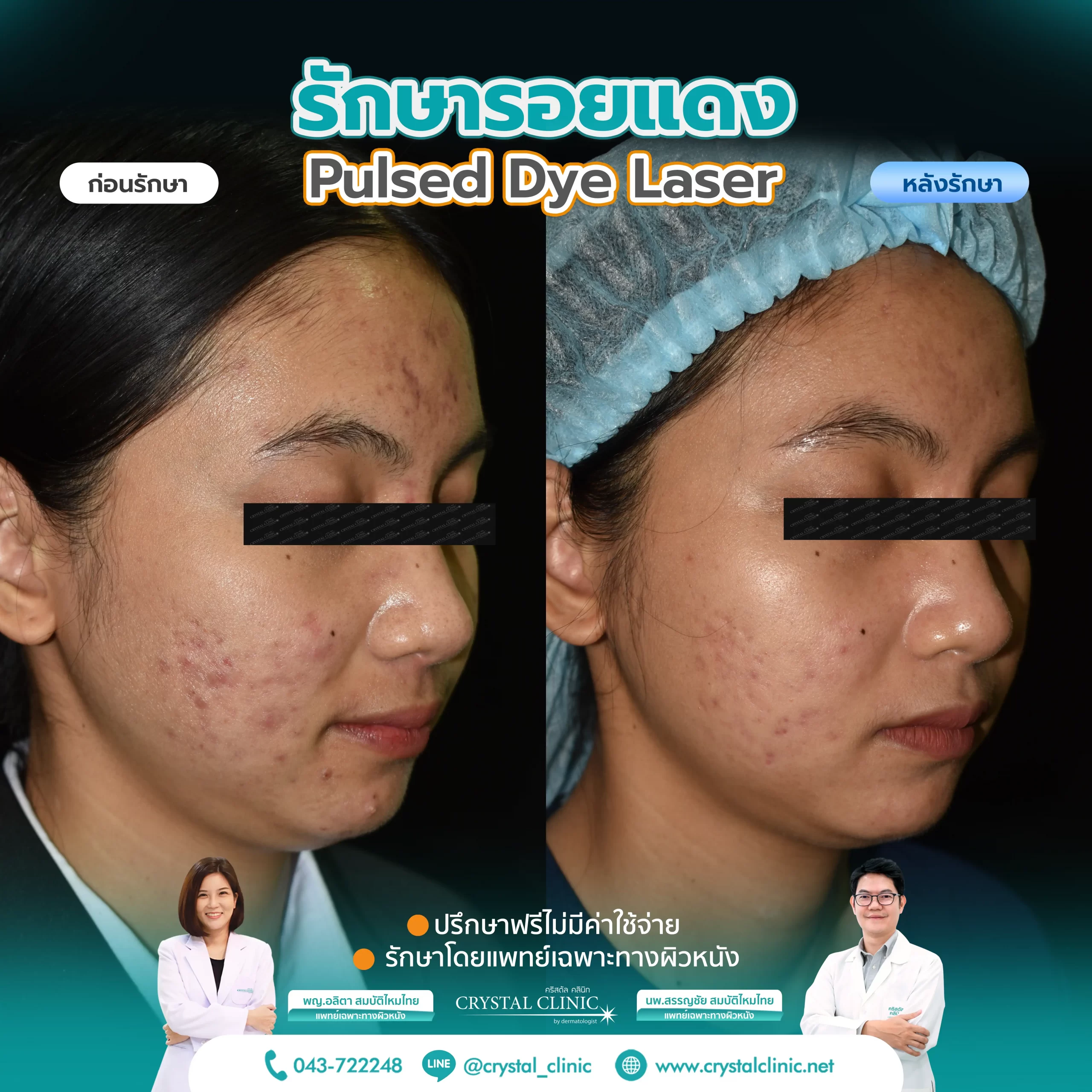 PDL Laser รักษารอยแดง รอยแดงสิว ด้วยเลเซอร์ คริสตัลคลินิก มหาสารคาม