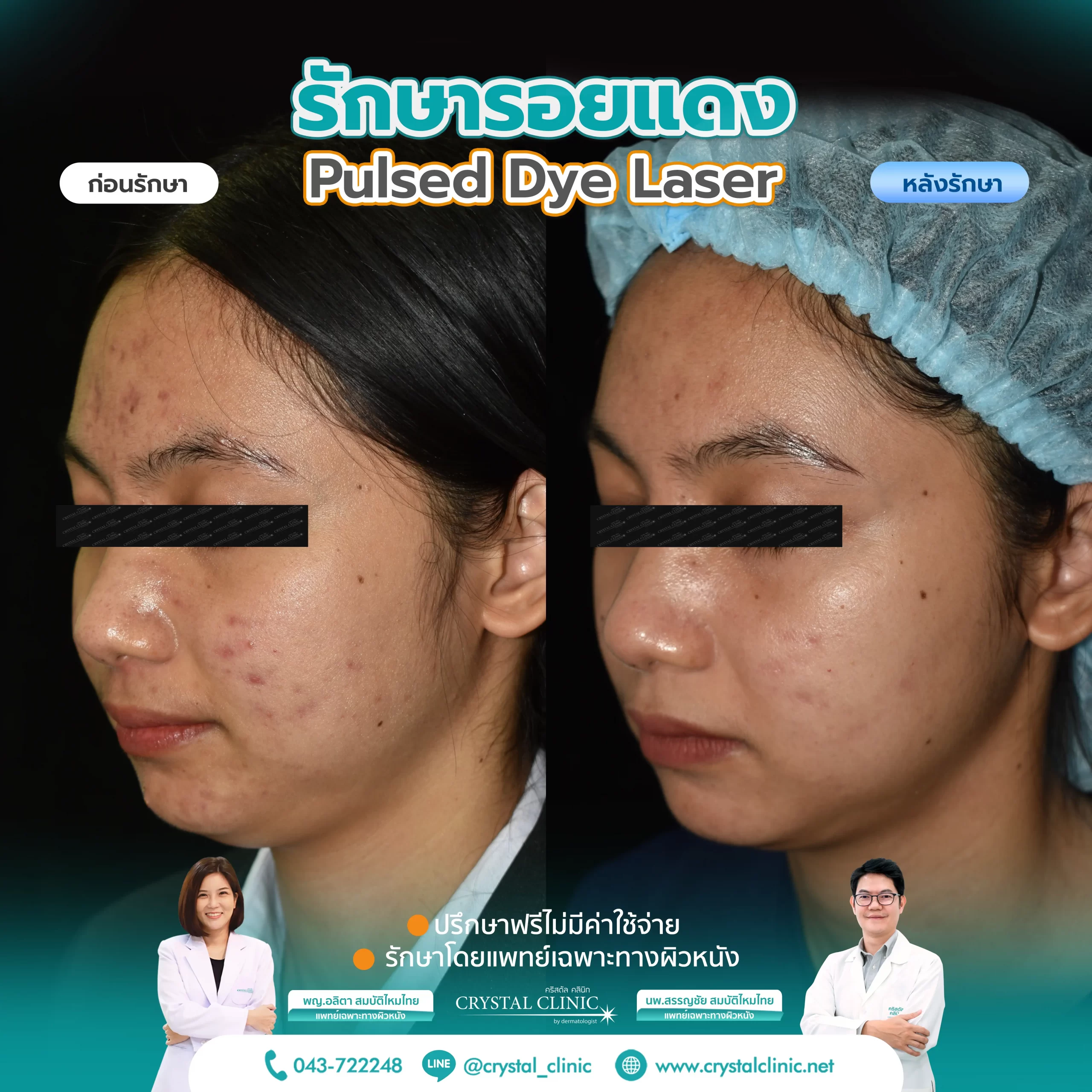 PDL Laser รักษารอยแดง รอยแดงสิว ด้วยเลเซอร์ คริสตัลคลินิก มหาสารคาม