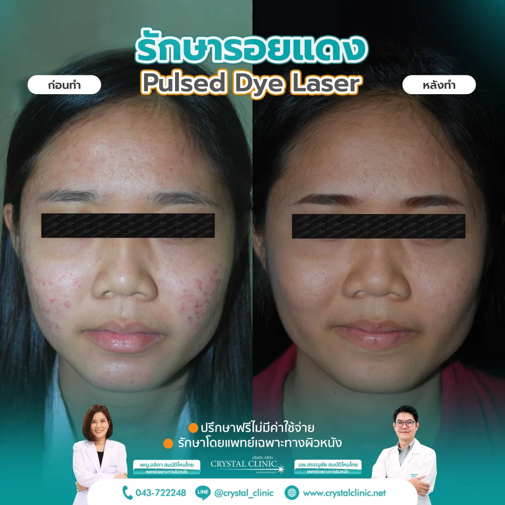 PDL Laser รักษารอยแดง รอยแดงสิว ด้วยเลเซอร์ คริสตัลคลินิก มหาสารคาม PDL Laser รักษารอยแดง รอยแดงสิว ด้วยเลเซอร์ คริสตัลคลินิก มหาสารคาม