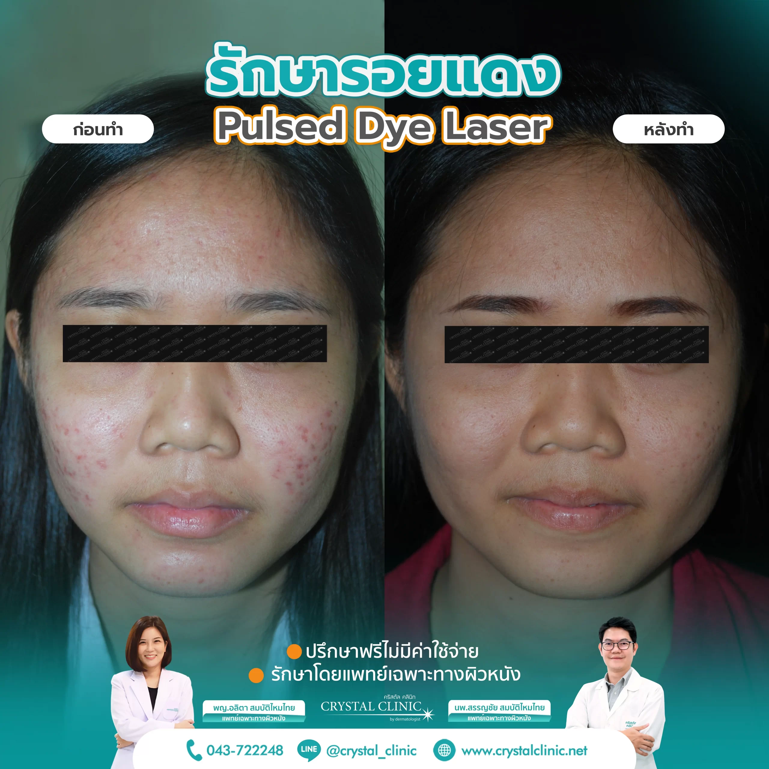 PDL Laser รักษารอยแดง รอยแดงสิว ด้วยเลเซอร์ คริสตัลคลินิก มหาสารคาม