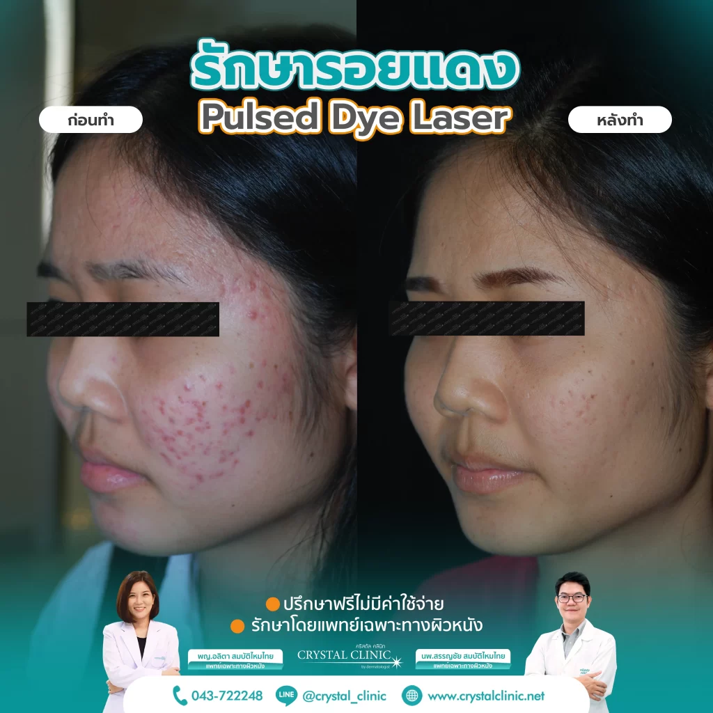 PDL Laser รักษารอยแดง รอยแดงสิว ด้วยเลเซอร์ คริสตัลคลินิก มหาสารคาม PDL Laser รักษารอยแดง รอยแดงสิว ด้วยเลเซอร์ คริสตัลคลินิก มหาสารคาม