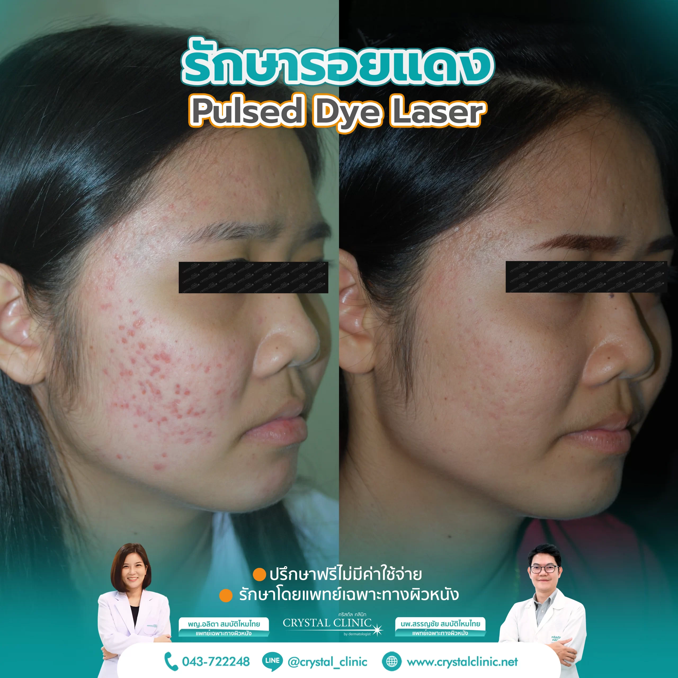 PDL Laser รักษารอยแดง รอยแดงสิว ด้วยเลเซอร์ คริสตัลคลินิก มหาสารคาม