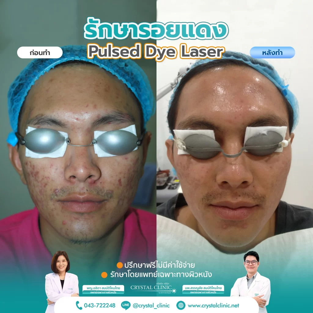 PDL Laser รักษารอยแดง รอยแดงสิว ด้วยเลเซอร์ คริสตัลคลินิก มหาสารคาม PDL Laser รักษารอยแดง รอยแดงสิว ด้วยเลเซอร์ คริสตัลคลินิก มหาสารคาม