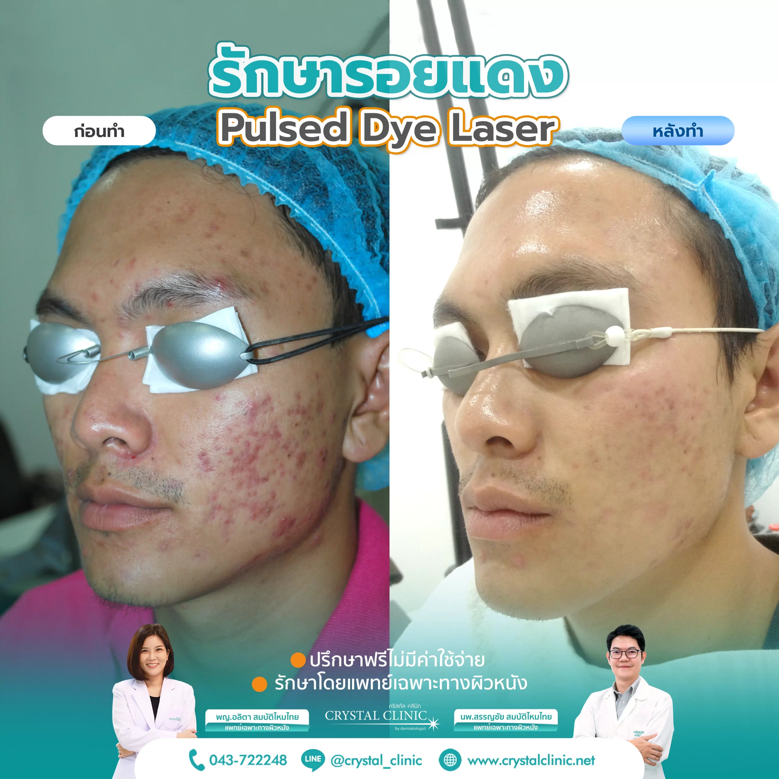 PDL Laser รักษารอยแดง รอยแดงสิว ด้วยเลเซอร์ คริสตัลคลินิก มหาสารคาม