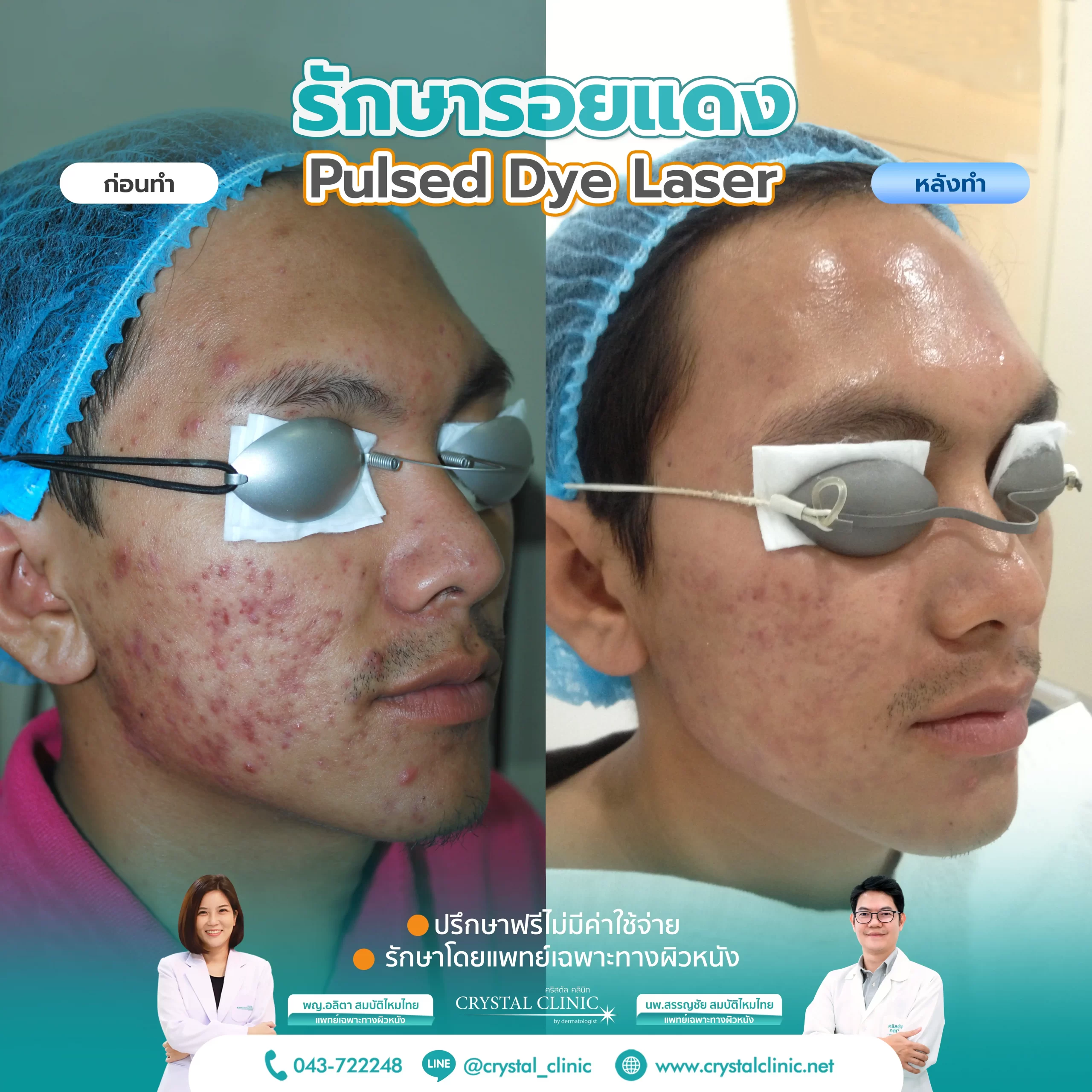 PDL Laser รักษารอยแดง รอยแดงสิว ด้วยเลเซอร์ คริสตัลคลินิก มหาสารคาม