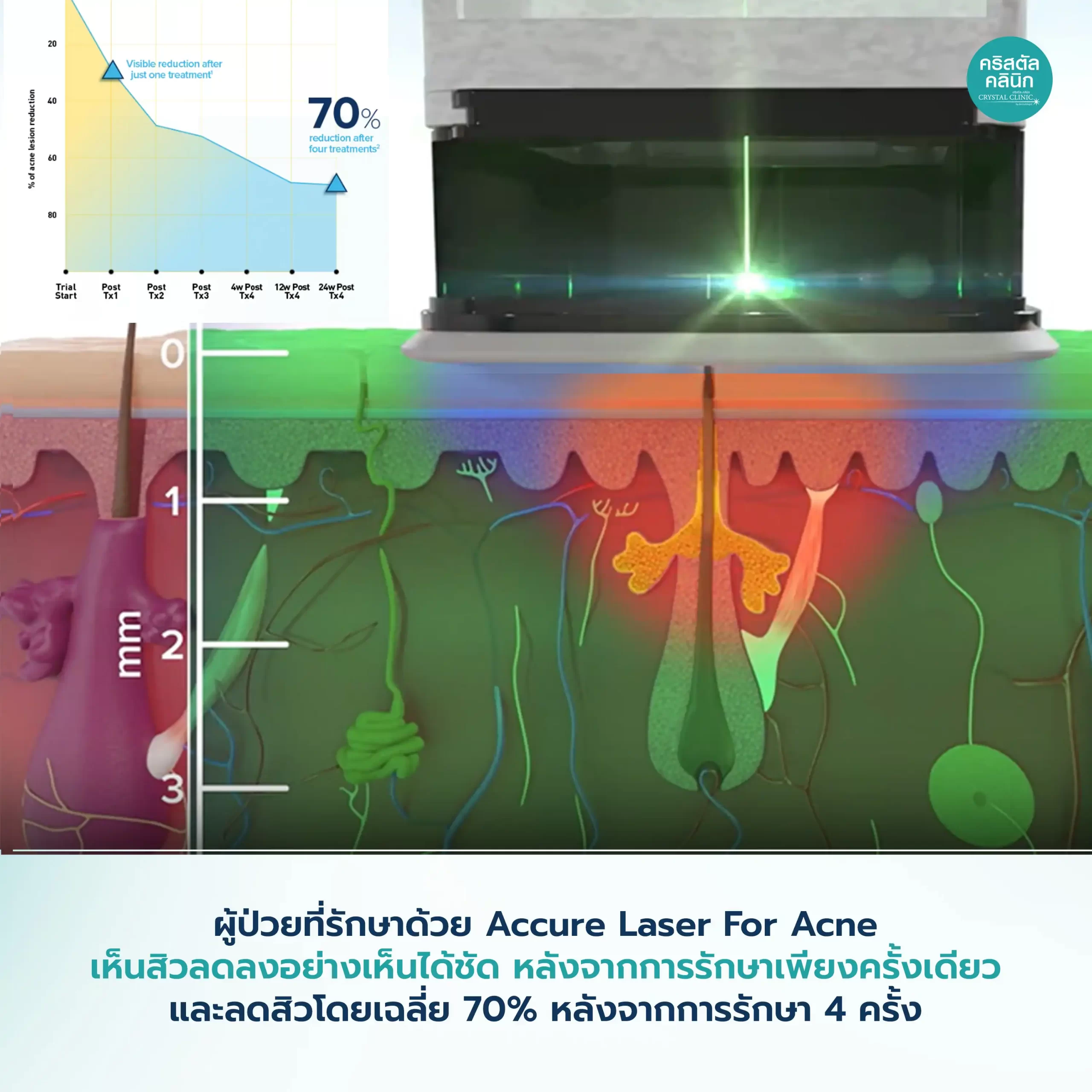 Accure-Laser-For-Acne-สิวลดลงโดยเฉลี่ยน-70-หลังการรักษา-4-ครั้ง