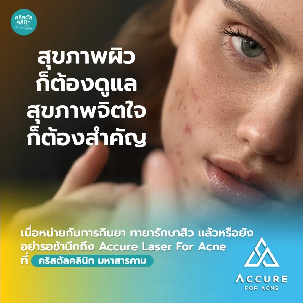 Accure Laser For Acne สุขภาพผิวต้องดูแลสุขภาพจิตใจก็ต้องสำคัญ Accure Laser For Acne สุขภาพผิวต้องดูแลสุขภาพจิตใจก็ต้องสำคัญ