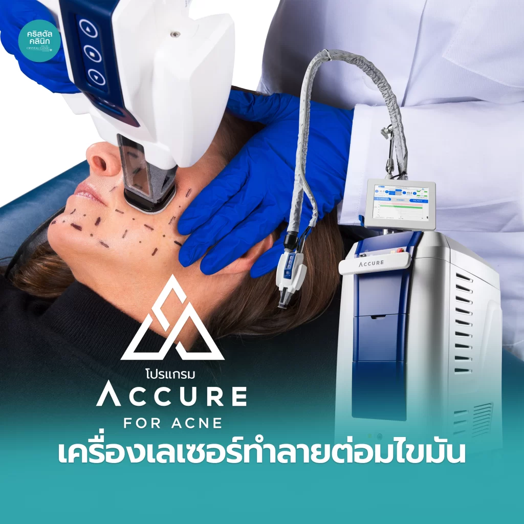 Accure Laser For Acne เครื่องเลเซอร์ทำลายต่อมไขมัน รักษาสิว