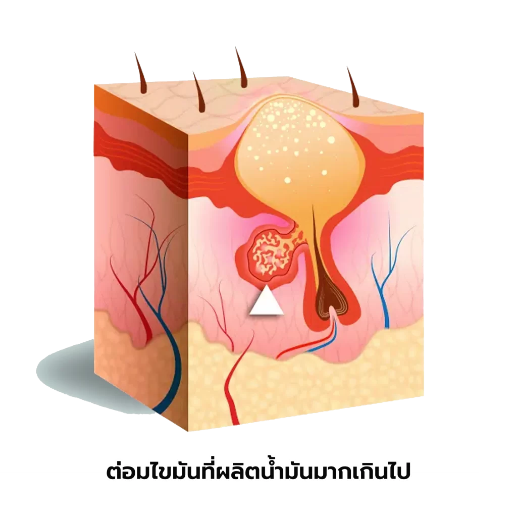 ภาพแสดงไขมันในน้ำมันไม่เพียงแต่ ภาพแสดงไขมันในน้ำมันไม่เพียงแต่