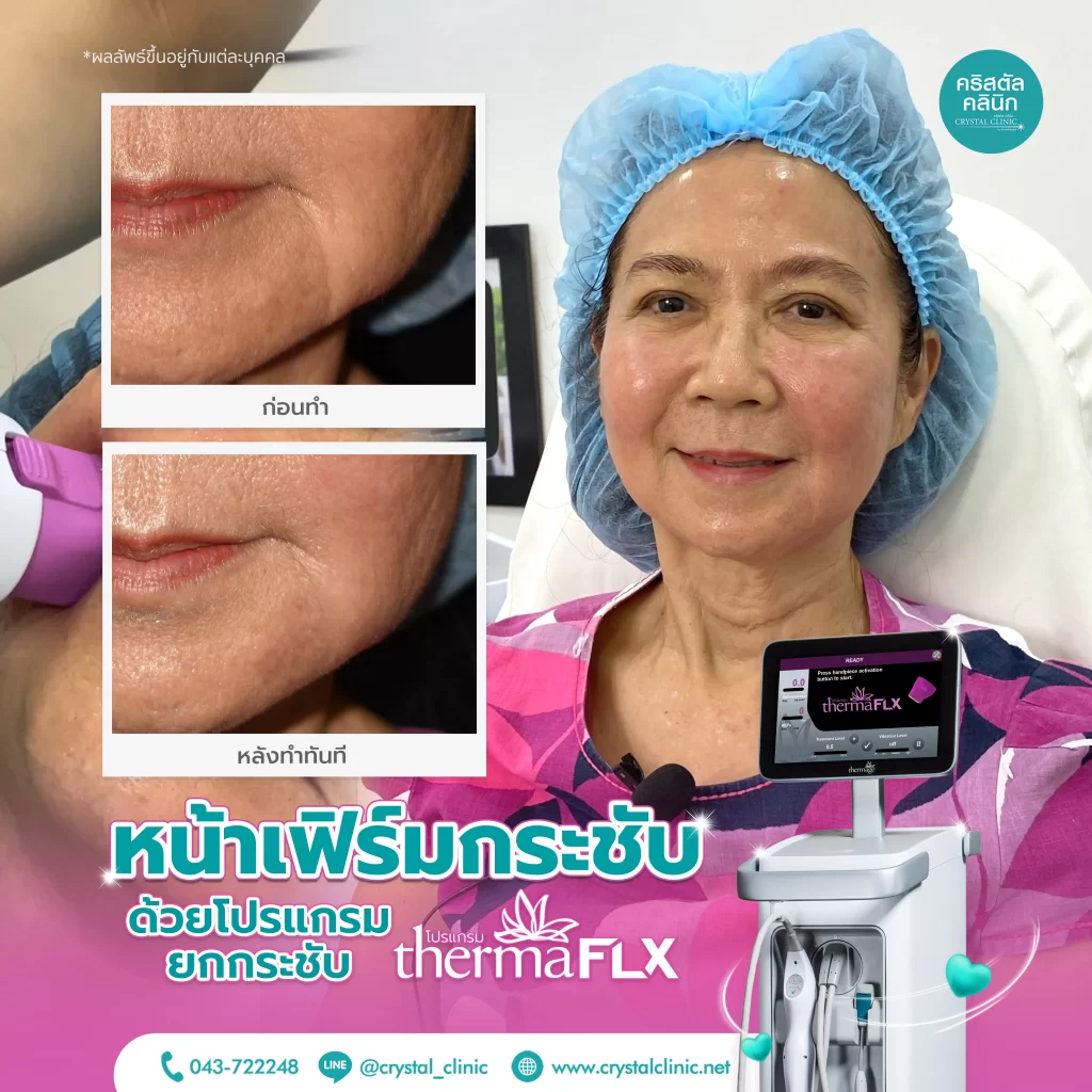 รีวิว ยกกระชับใบหน้า ด้วยโปรแกรม Thermage FLX