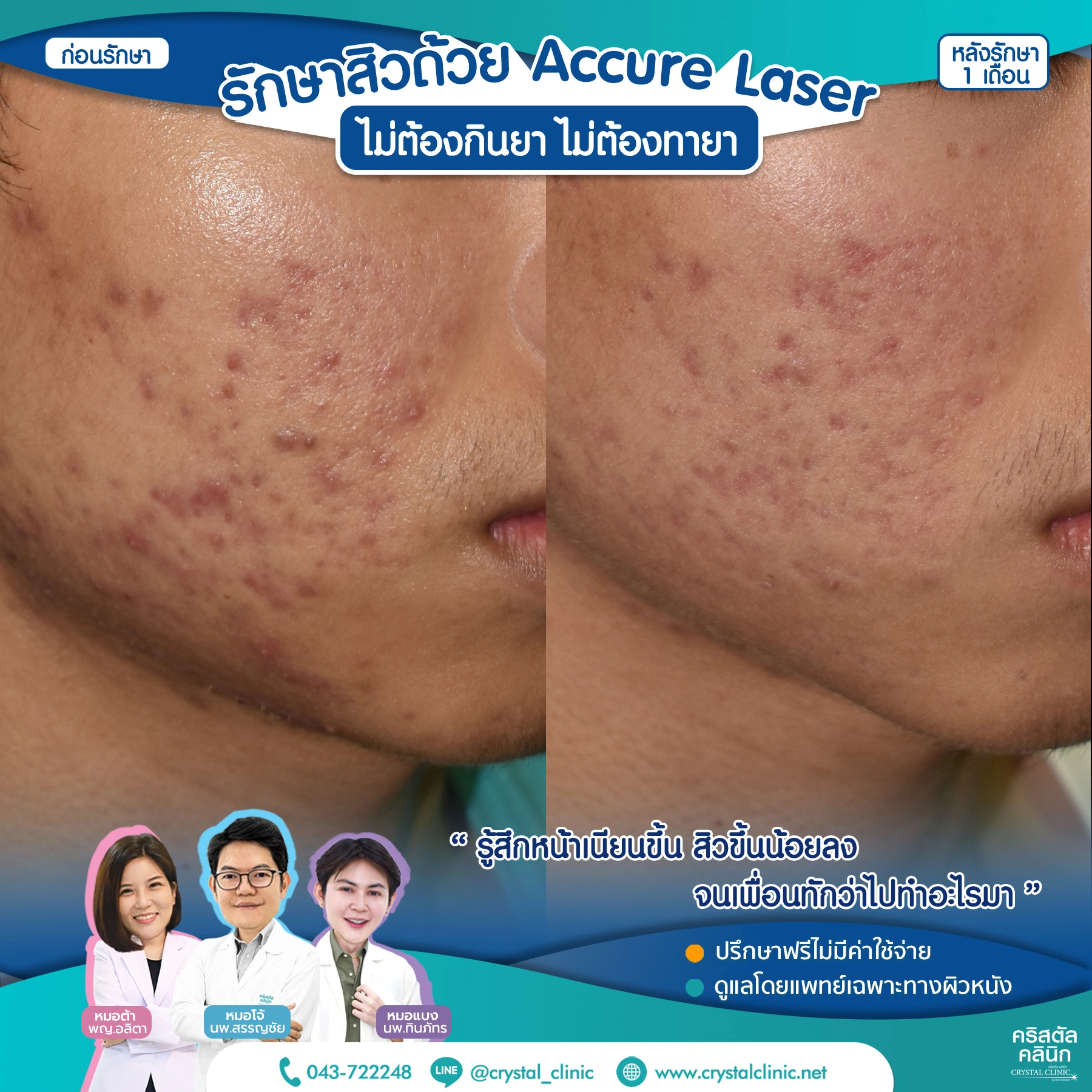 เคสรีวิวรักษาสิว ด้วย Accure Laser (แอคเคียว เลเซอร์) เลเซอร์ทำลายต่อมไขมันที่ผลิตไขมันมากเกินไป (ซึ่งเป็นสาเหตุหลักของการเกิดสิว) ให้ฝ่อตัวลง ด้วยเทคโนโลยี 1726 นาโนเมตร หลังรักษา 1 เดือน