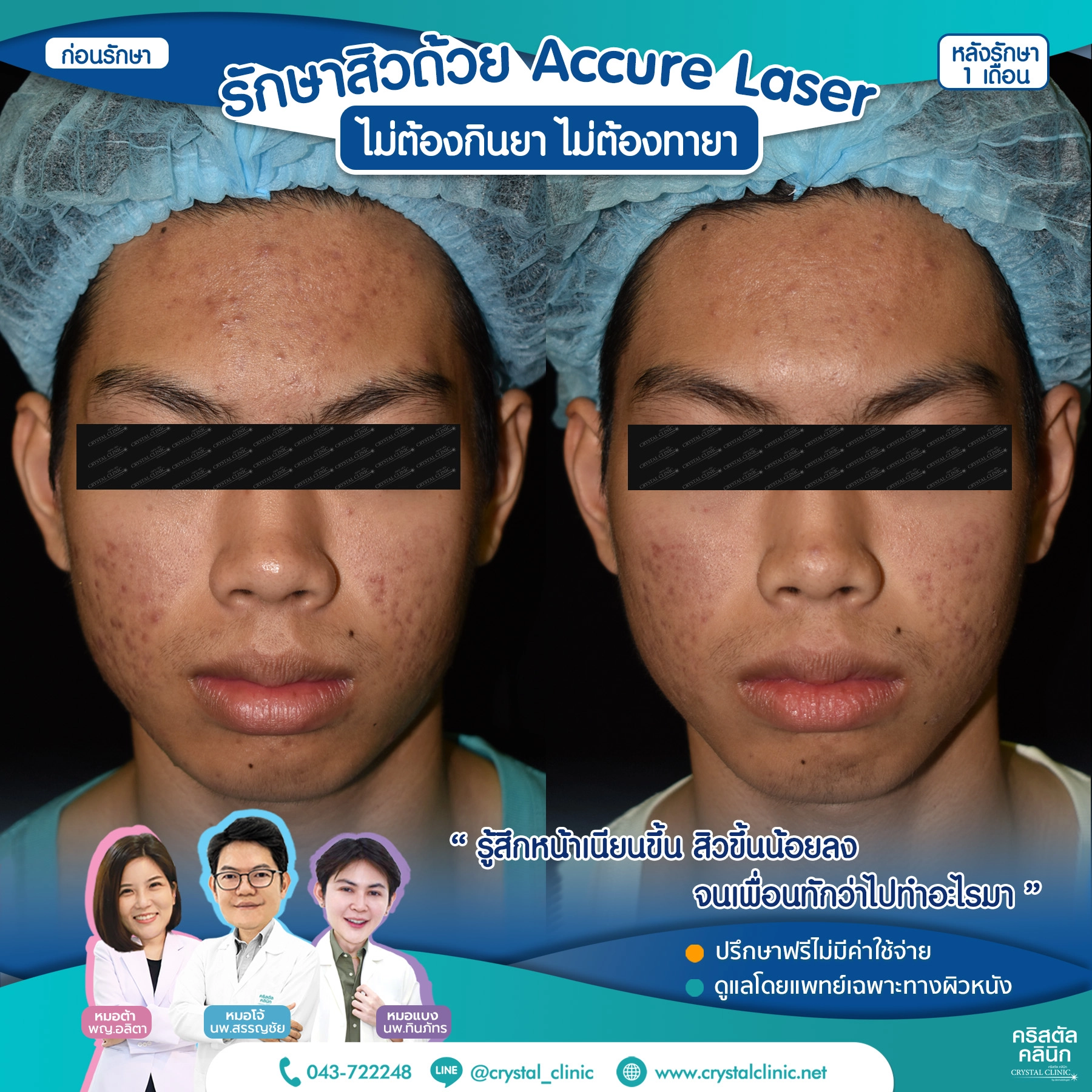 เคสรีวิวรักษาสิว ด้วย Accure Laser (แอคเคียว เลเซอร์) เลเซอร์ทำลายต่อมไขมันที่ผลิตไขมันมากเกินไป (ซึ่งเป็นสาเหตุหลักของการเกิดสิว) ให้ฝ่อตัวลง ด้วยเทคโนโลยี 1726 นาโนเมตร หลังรักษา 1 เดือน