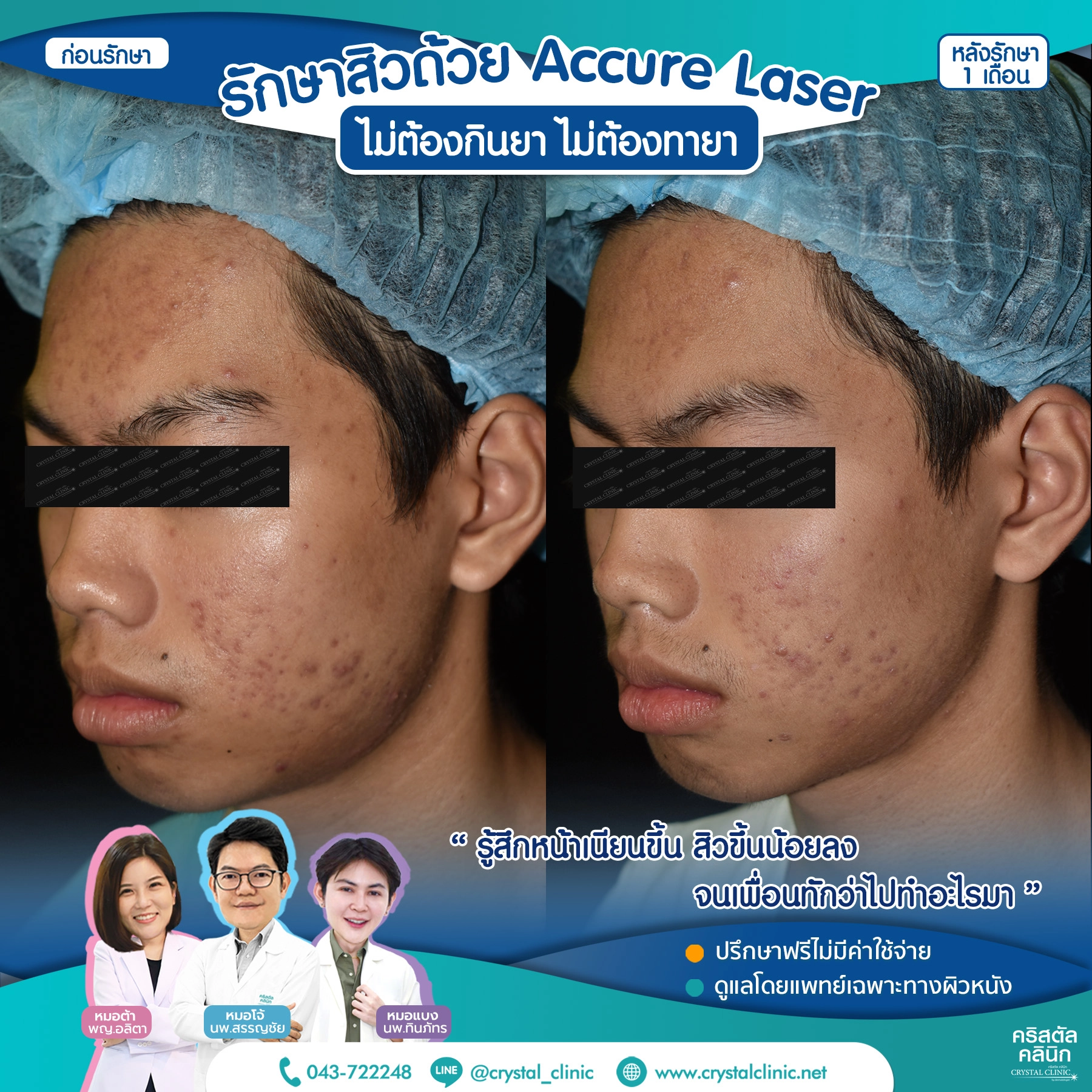 เคสรีวิวรักษาสิว ด้วย Accure Laser (แอคเคียว เลเซอร์) เลเซอร์ทำลายต่อมไขมันที่ผลิตไขมันมากเกินไป (ซึ่งเป็นสาเหตุหลักของการเกิดสิว) ให้ฝ่อตัวลง ด้วยเทคโนโลยี 1726 นาโนเมตร หลังรักษา 1 เดือน