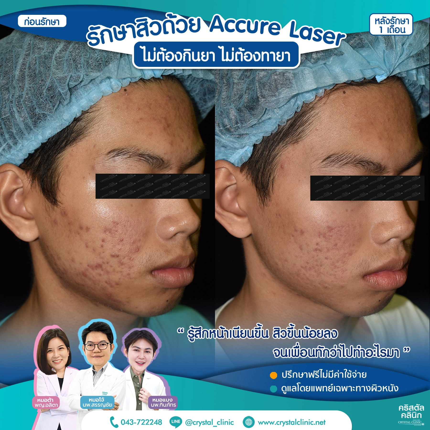 เคสรีวิวรักษาสิว ด้วย Accure Laser (แอคเคียว เลเซอร์) เลเซอร์ทำลายต่อมไขมันที่ผลิตไขมันมากเกินไป (ซึ่งเป็นสาเหตุหลักของการเกิดสิว) ให้ฝ่อตัวลง ด้วยเทคโนโลยี 1726 นาโนเมตร หลังรักษา 1 เดือน