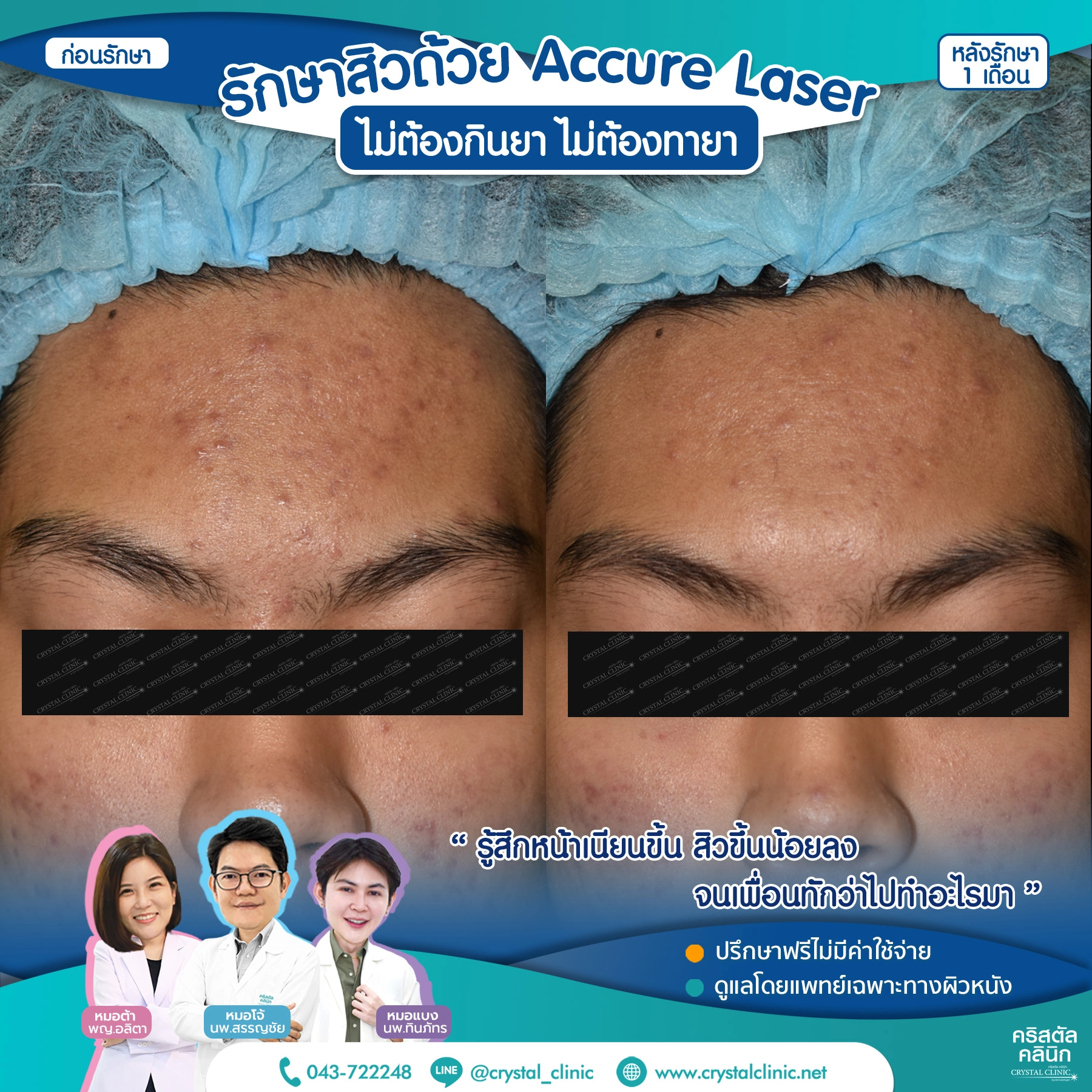 เคสรีวิวรักษาสิว ด้วย Accure Laser (แอคเคียว เลเซอร์) เลเซอร์ทำลายต่อมไขมันที่ผลิตไขมันมากเกินไป (ซึ่งเป็นสาเหตุหลักของการเกิดสิว) ให้ฝ่อตัวลง ด้วยเทคโนโลยี 1726 นาโนเมตร หลังรักษา 1 เดือน