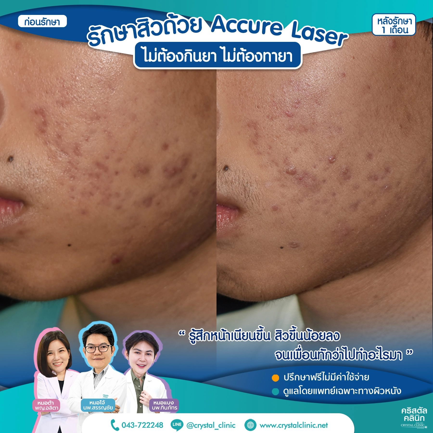เคสรีวิวรักษาสิว ด้วย Accure Laser (แอคเคียว เลเซอร์) เลเซอร์ทำลายต่อมไขมันที่ผลิตไขมันมากเกินไป (ซึ่งเป็นสาเหตุหลักของการเกิดสิว) ให้ฝ่อตัวลง ด้วยเทคโนโลยี 1726 นาโนเมตร หลังรักษา 1 เดือน