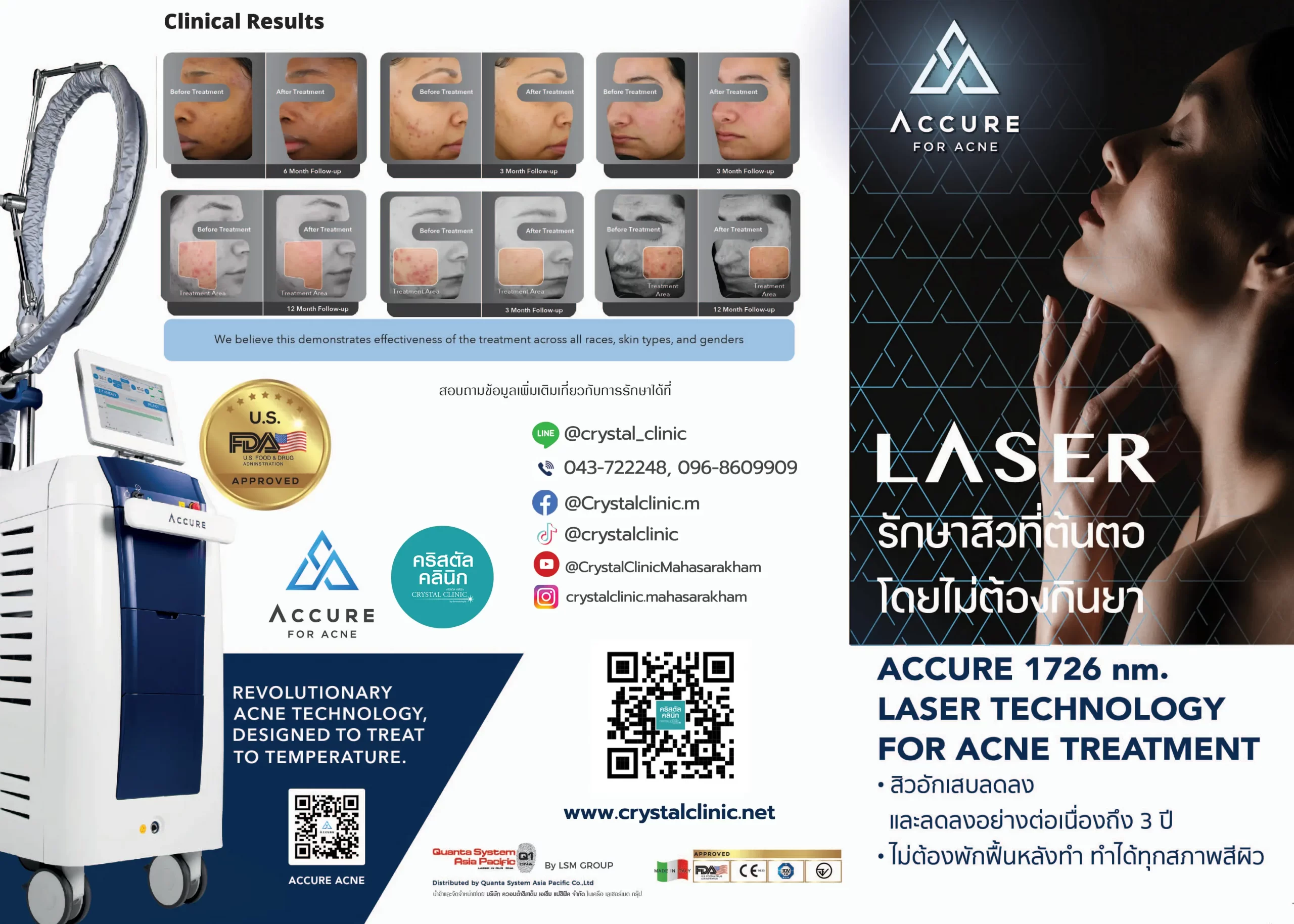 โบรชัวร์ Accure Laser โบรชัวร์ Accure Laser Accure Laser For Acne (คาร์แคร์เลเซอร์) เลเซอร์ทำลายไขมันส่วนเกินไขมันในเลือด (ซึ่งรวมถึงอาหารจานหลักสิว)