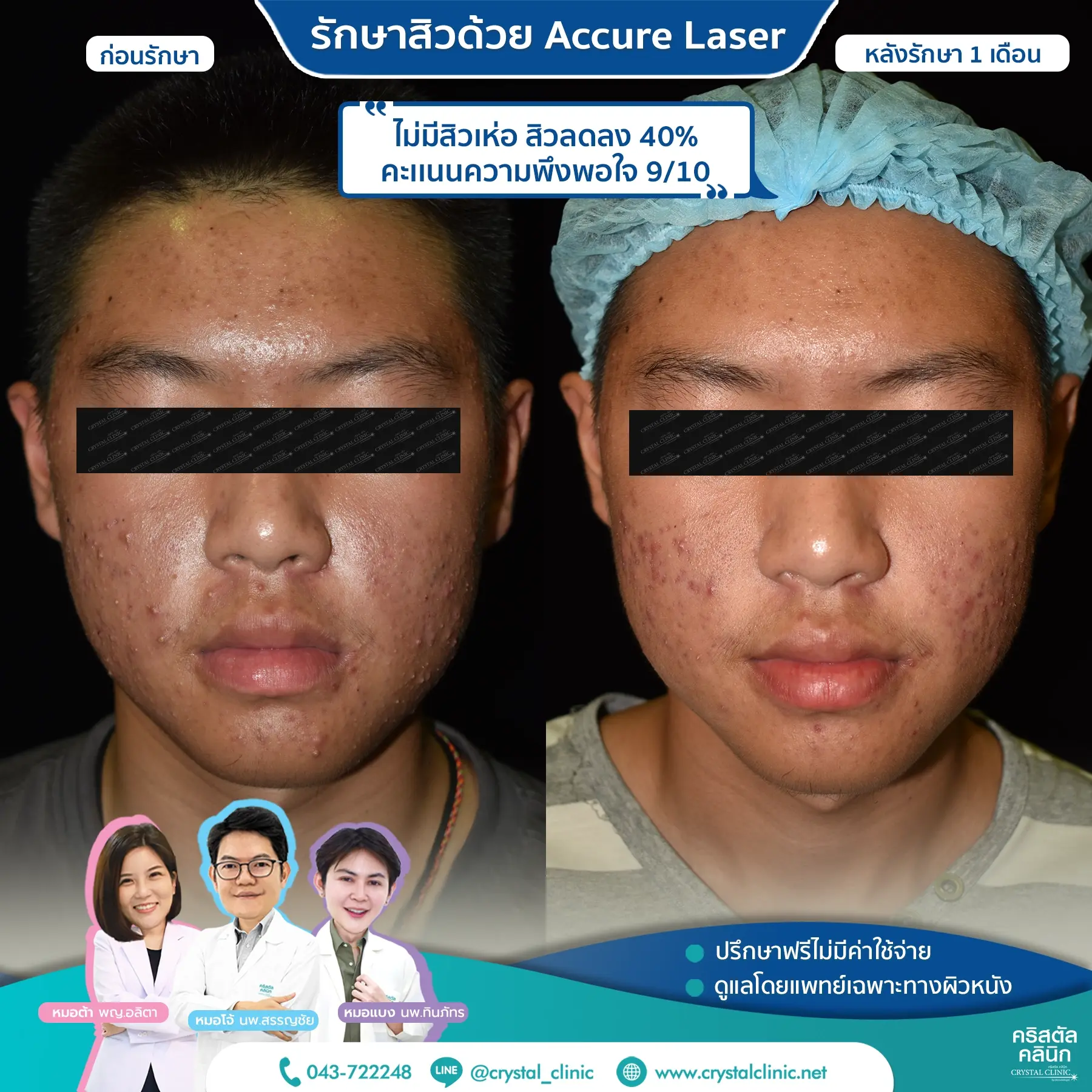 เคสรีวิวรักษาสิว ด้วย Accure Laser (แอคเคียว เลเซอร์) เลเซอร์ทำลายต่อมไขมันที่ผลิตไขมันมากเกินไป (ซึ่งเป็นสาเหตุหลักของการเกิดสิว) ให้ฝ่อตัวลง ด้วยเทคโนโลยี 1726 นาโนเมตร หลังรักษา 4 สัปดาห์