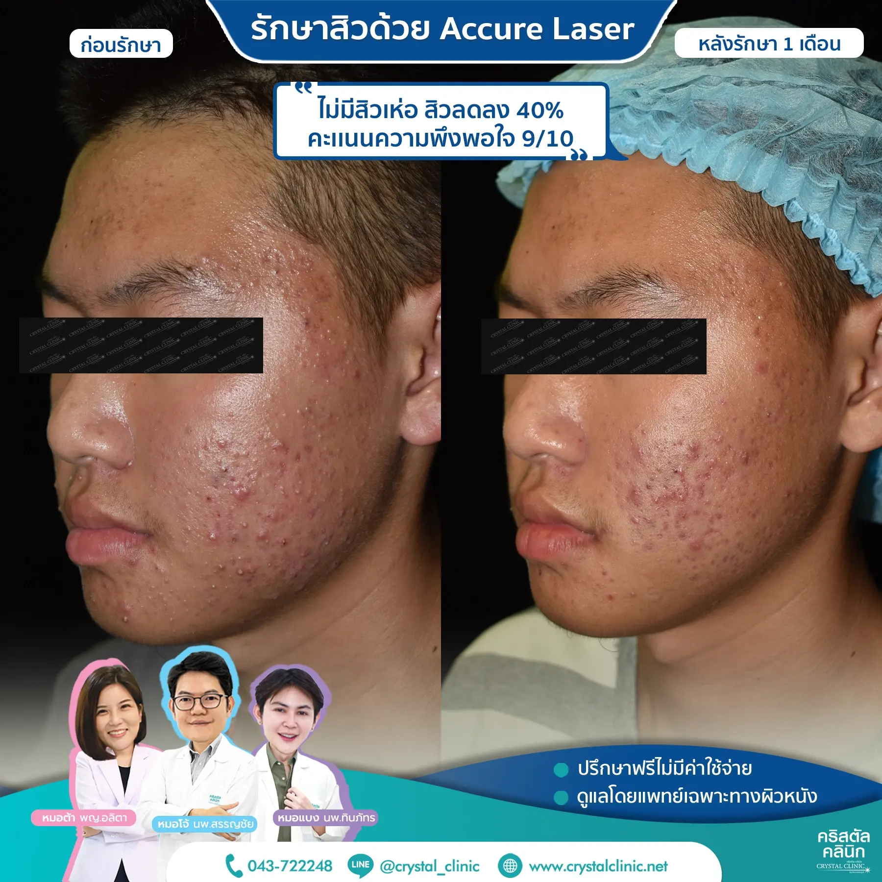 เคสรีวิวรักษาสิว ด้วย Accure Laser (แอคเคียว เลเซอร์) เลเซอร์ทำลายต่อมไขมันที่ผลิตไขมันมากเกินไป (ซึ่งเป็นสาเหตุหลักของการเกิดสิว) ให้ฝ่อตัวลง ด้วยเทคโนโลยี 1726 นาโนเมตร หลังรักษา 4 สัปดาห์