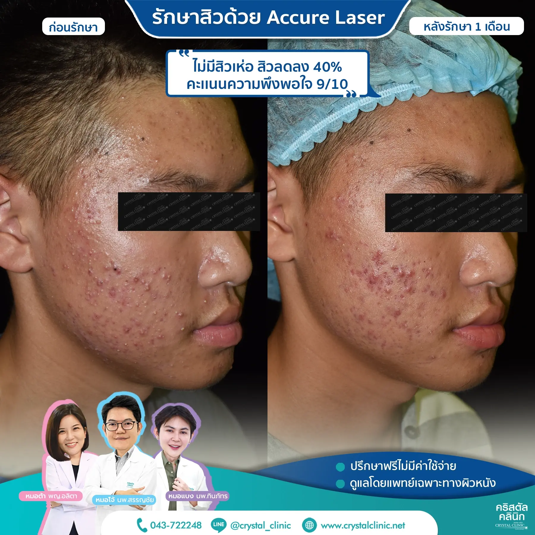 เคสรีวิวรักษาสิว ด้วย Accure Laser (แอคเคียว เลเซอร์) เลเซอร์ทำลายต่อมไขมันที่ผลิตไขมันมากเกินไป (ซึ่งเป็นสาเหตุหลักของการเกิดสิว) ให้ฝ่อตัวลง ด้วยเทคโนโลยี 1726 นาโนเมตร หลังรักษา 4 สัปดาห์