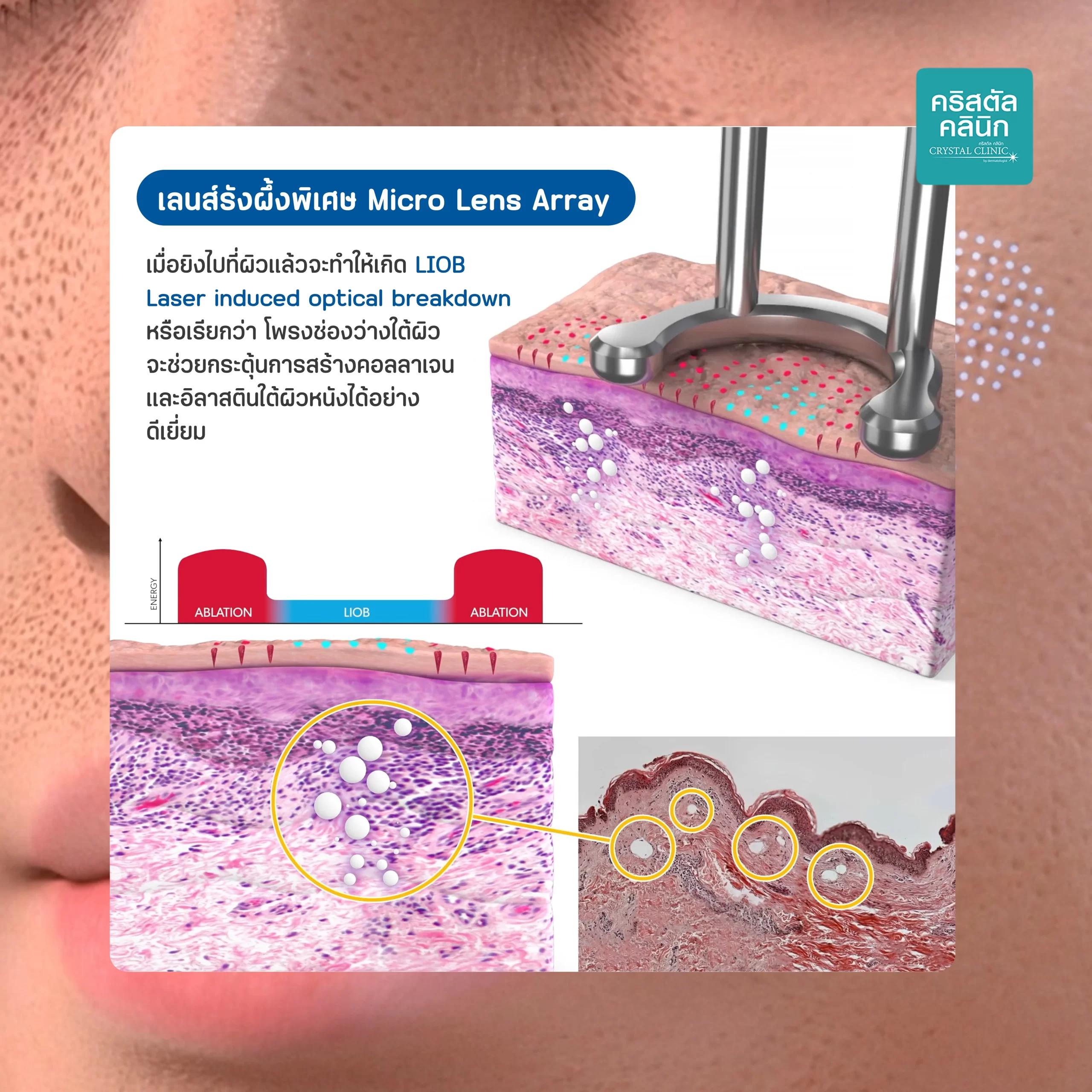 คืนผิวเรียบเนียนใส ไร้ริ้วรอย ด้วยพิโค่เลเซอร์ Discovery Pico Derm Laser เลเซอร์ที่วงการแพทย์ผิวหนังและความงามทั่วโลกยอมรับ