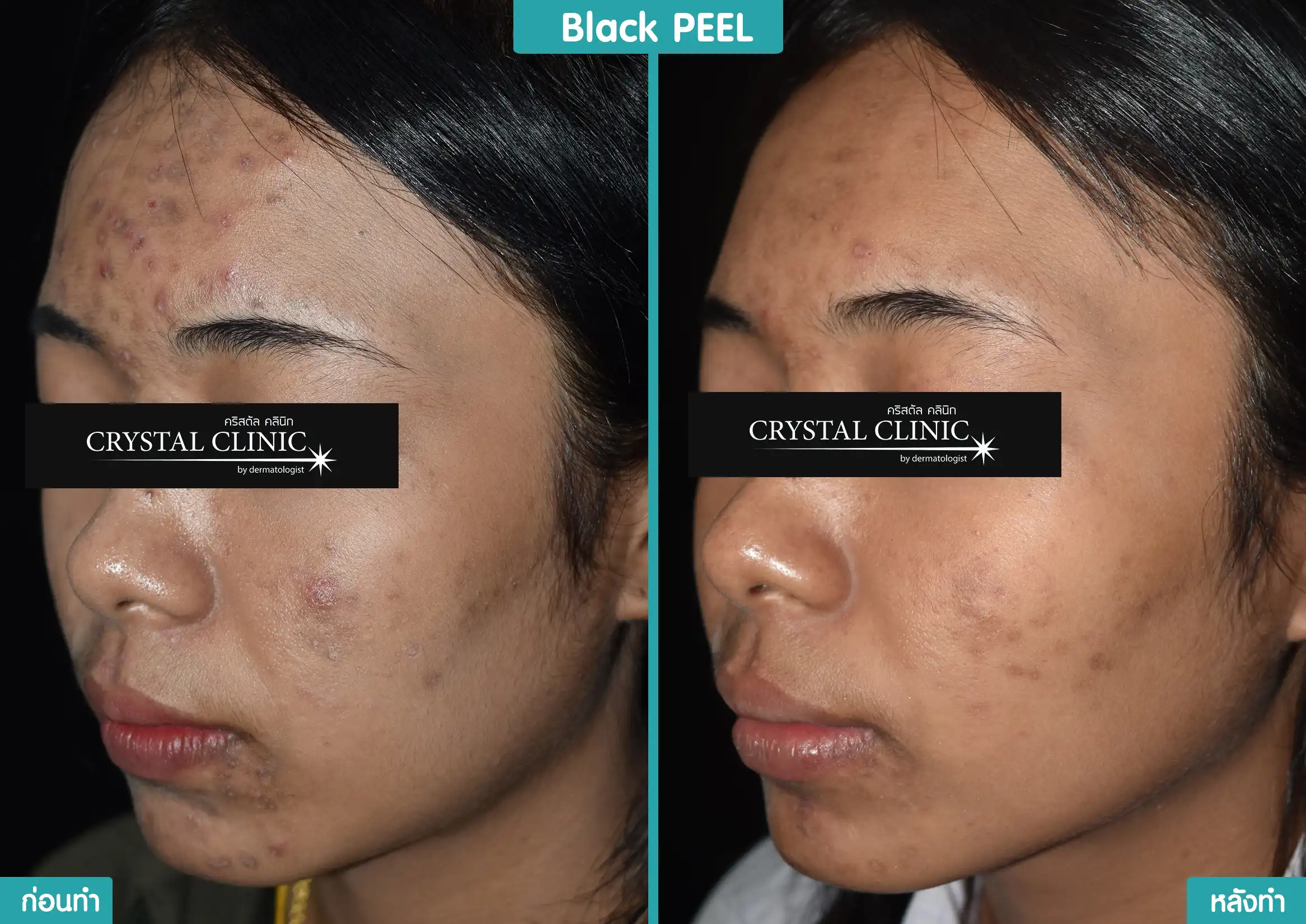 รีวิวหลังผลัดเซลล์ผิว รักษารอยดำ ด้วย Black Peel รีวิวหลังผลัดเซลล์ผิว รักษารอยดำ ด้วย Black Peel