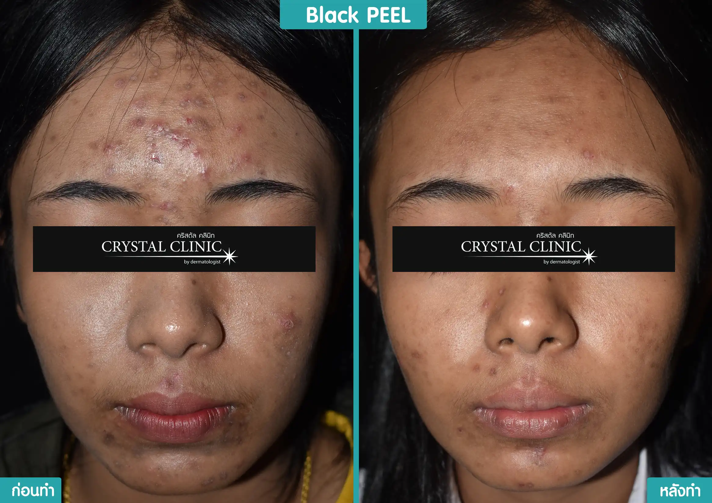รีวิวหลังผลัดเซลล์ผิว รักษารอยดำ ด้วย Black Peel รีวิวหลังผลัดเซลล์ผิว รักษารอยดำ ด้วย Black Peel
