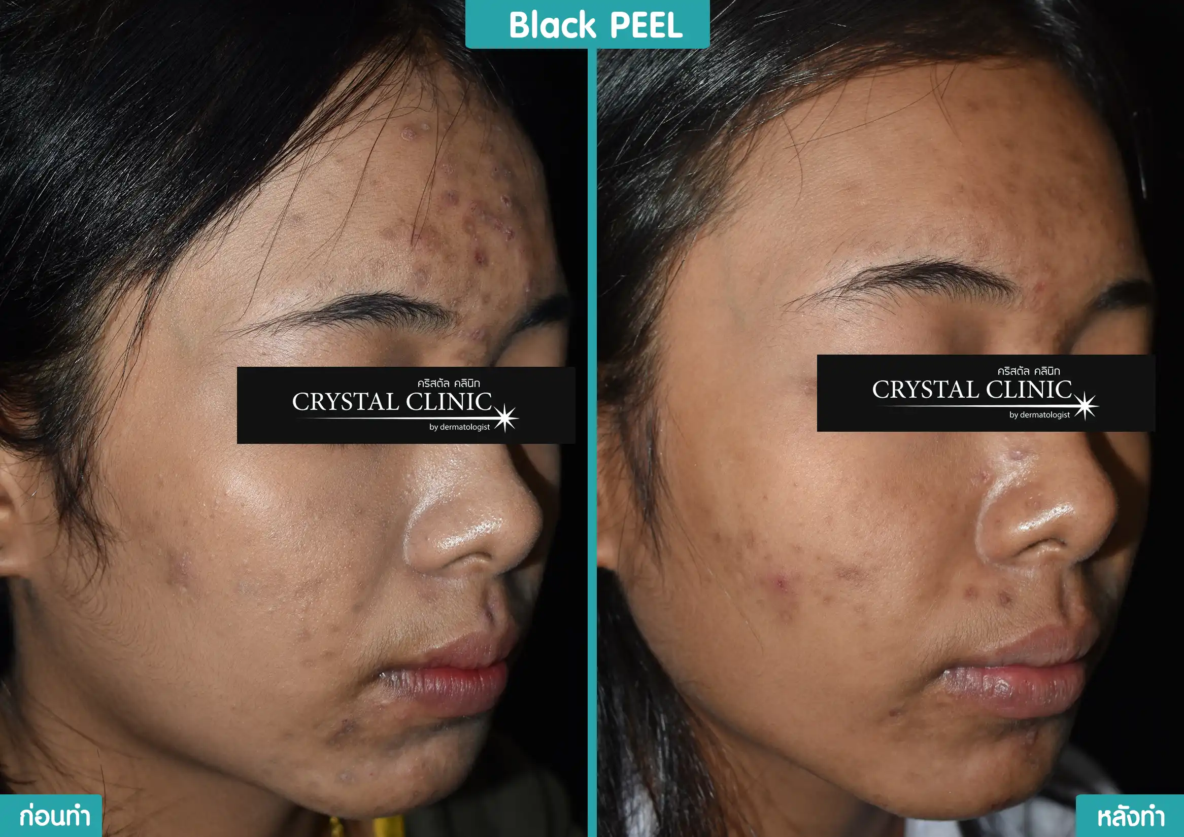 รีวิวหลังผลัดเซลล์ผิว รักษารอยดำ ด้วย Black Peel รีวิวหลังผลัดเซลล์ผิว รักษารอยดำ ด้วย Black Peel