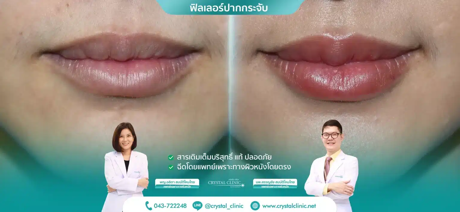 ฟิลเลอร์ปากกระจับ-1536x709