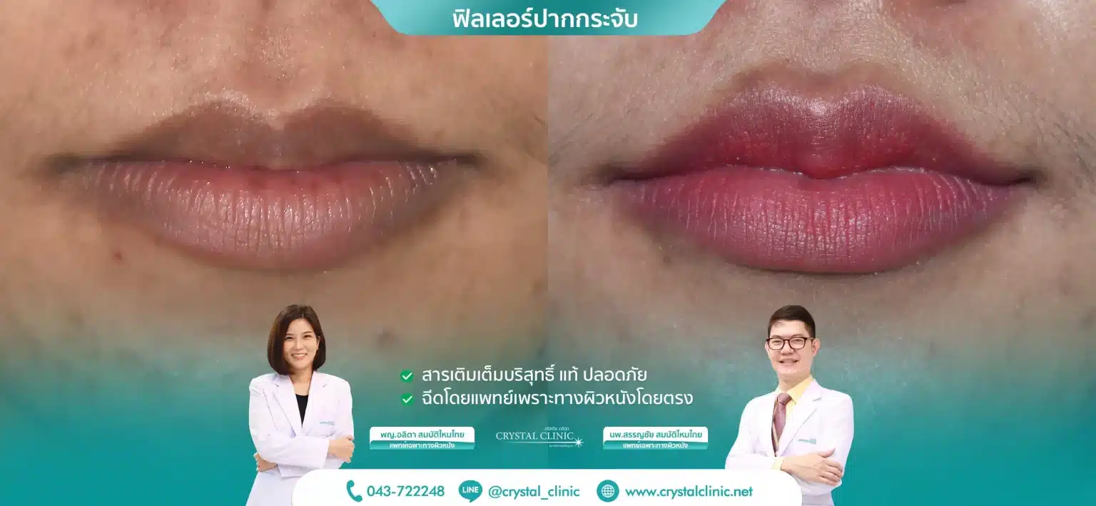 ฟิลเลอร์ปากกระจับ-2-1536x709