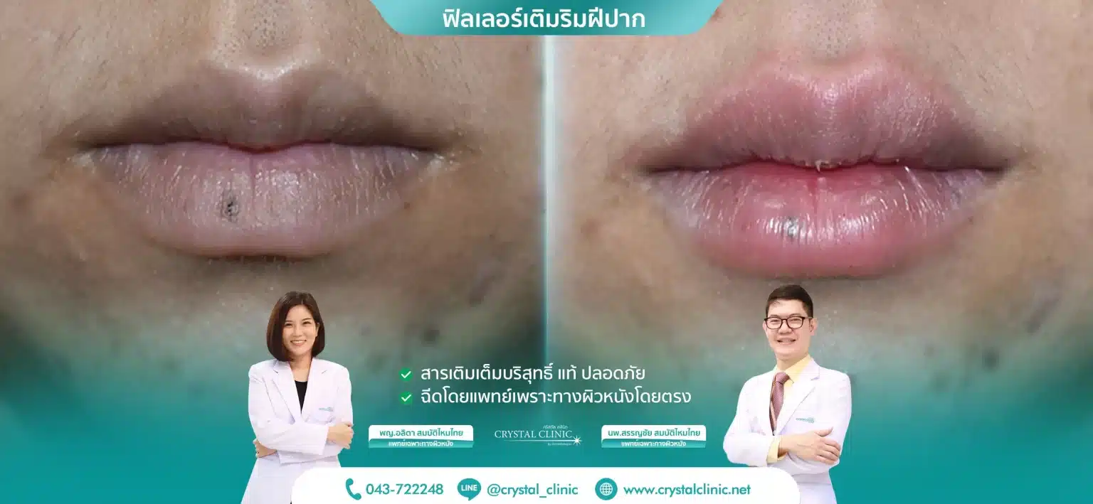 ฟิลเลอร์เติมริมฝีปาก-1536x709