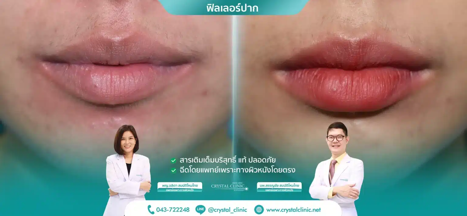 ฟิลเลอร์เติมเต็มปาก-1536x709