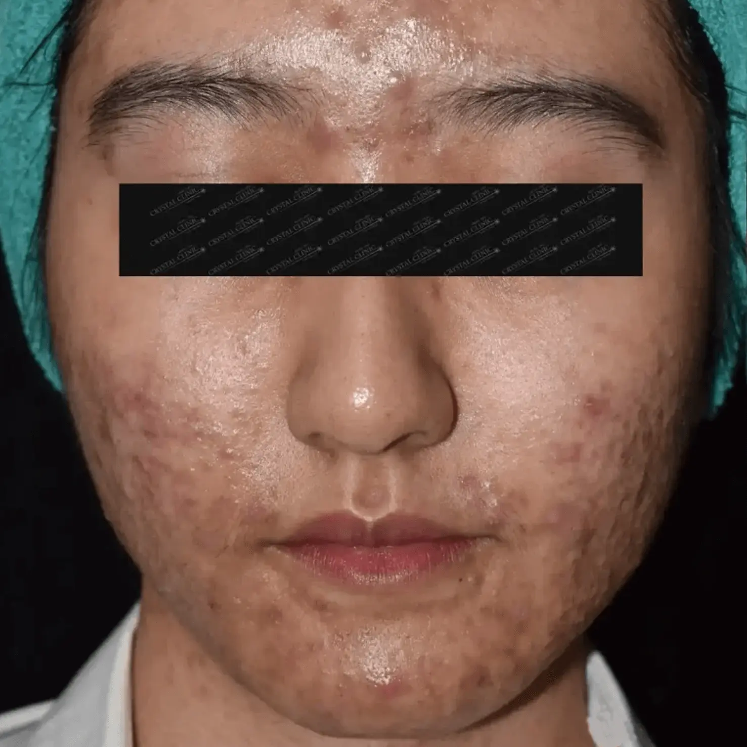 Acne 1