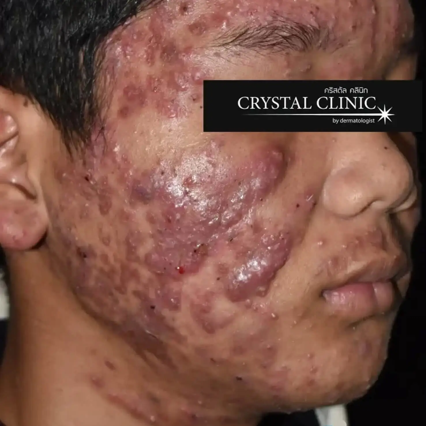 Acne 3