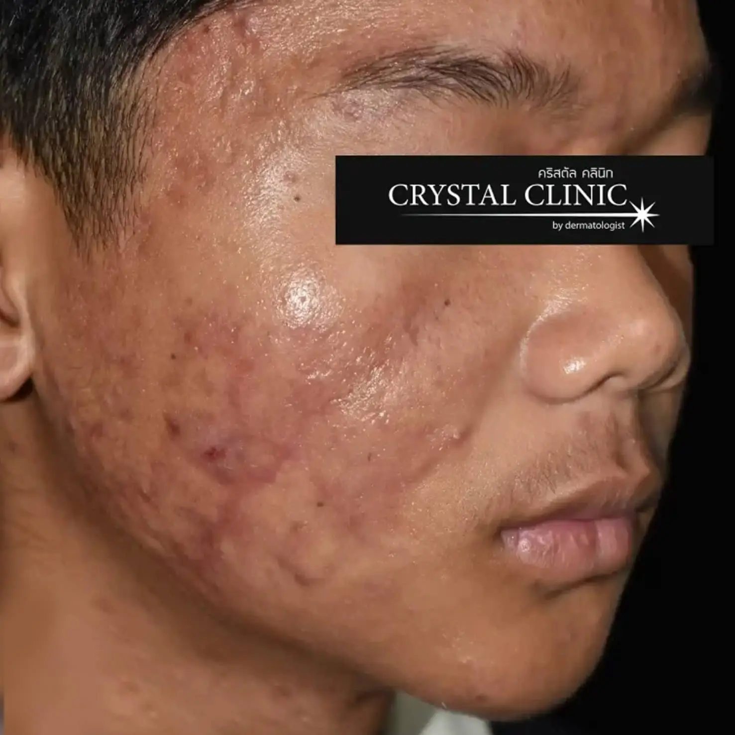 Acne 4