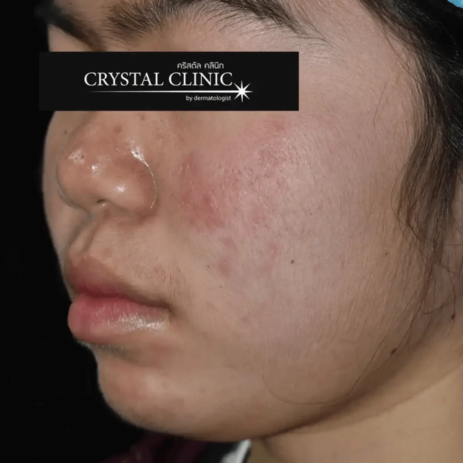 Acne 6