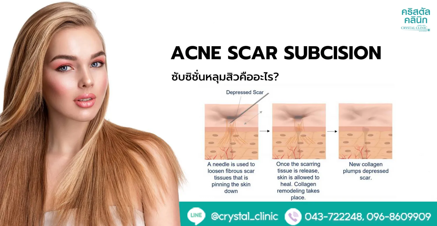 subcision คริสตัลคลินิกมหาสารคาม